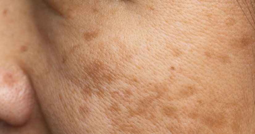 best melasma treatment in bangalore